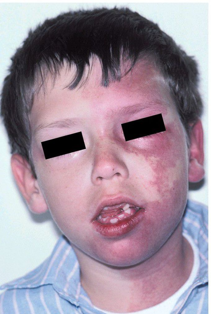 Sturge-Weber Syndrome.