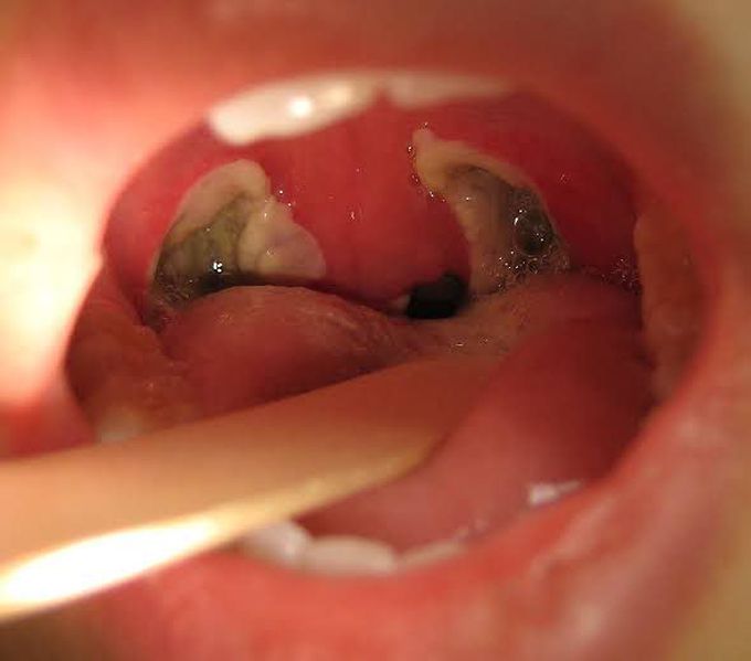 Tonsillectomy Complications