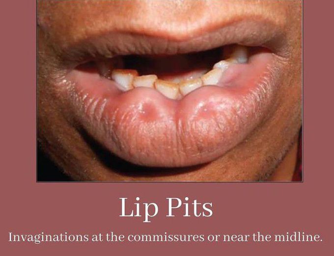 Lip Pits