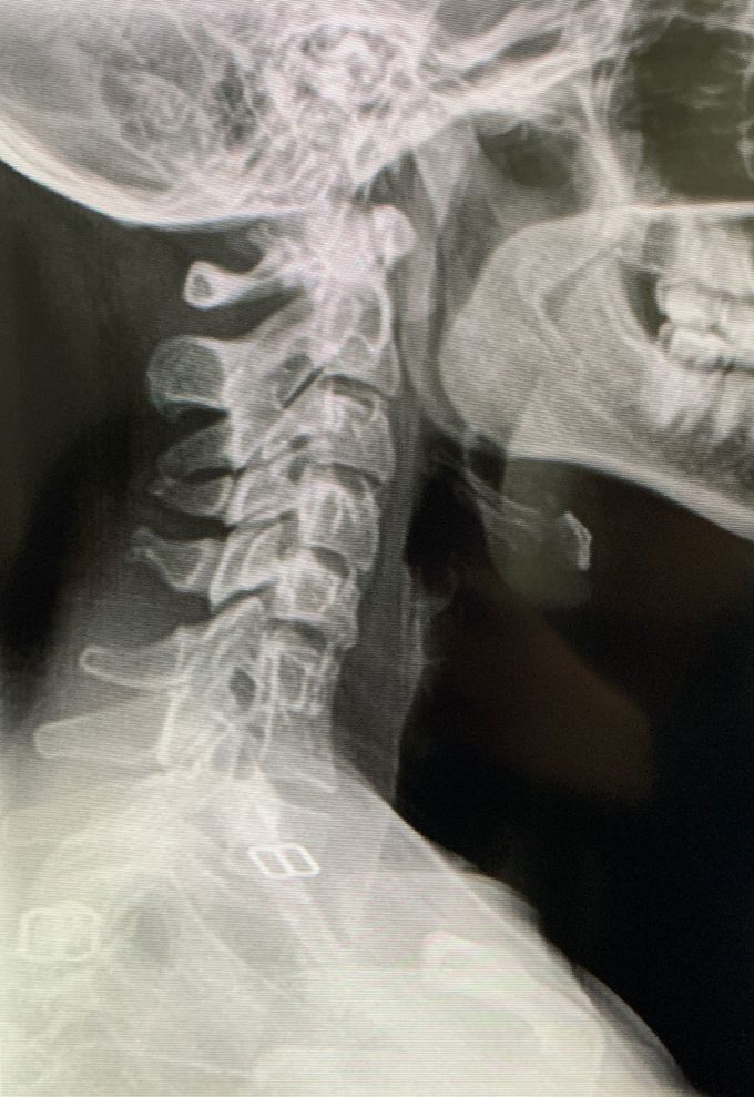 What is noticeable in this X-ray?
