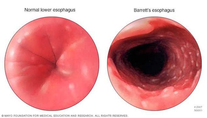 Causes of Barrets Esophagus