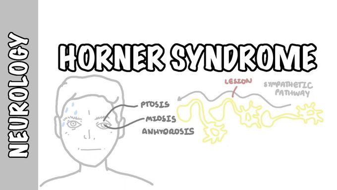 Horners Syndrome
