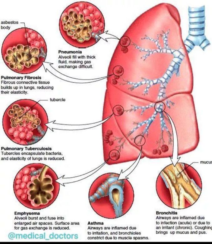 Disease of lung