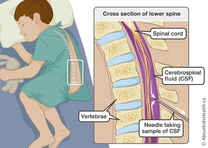 How is meningitis treated?