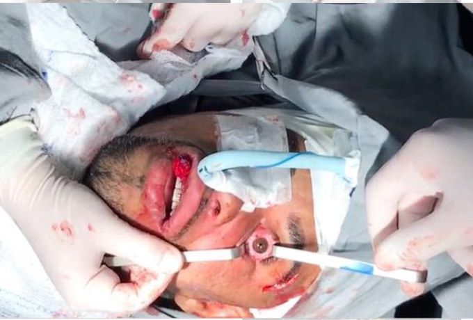 Eyeball Surgery