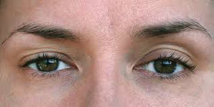 Ptosis symptoms