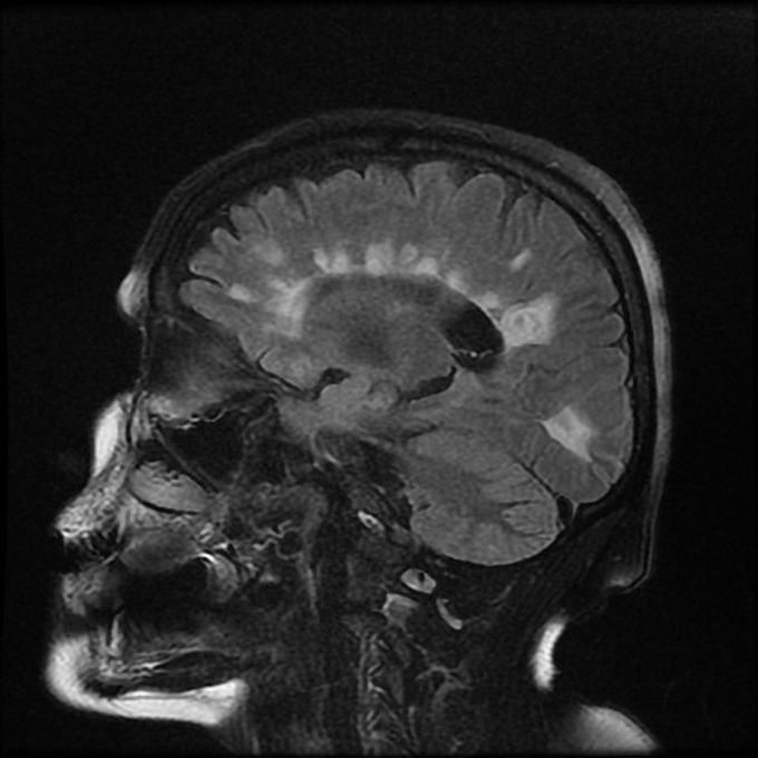 MRI Findings in Multiple Sclerosis