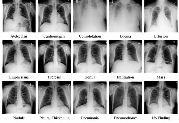 Chest X-ray Review