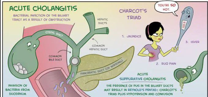 Cause of Cholangitis