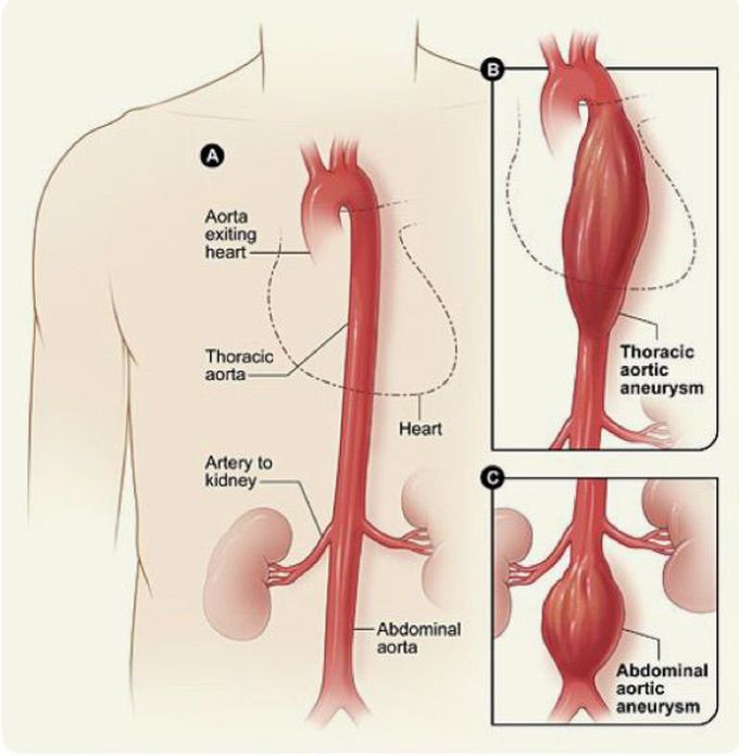 Disease of the aorta