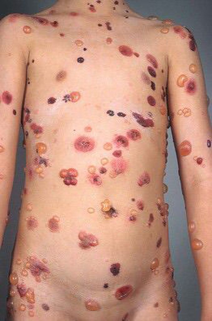 Bullous Pemphigoid