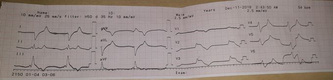 Hyperkalaemia