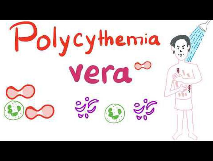 Polycythemia Vera (PV)