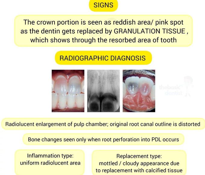 Internal Resorption IV