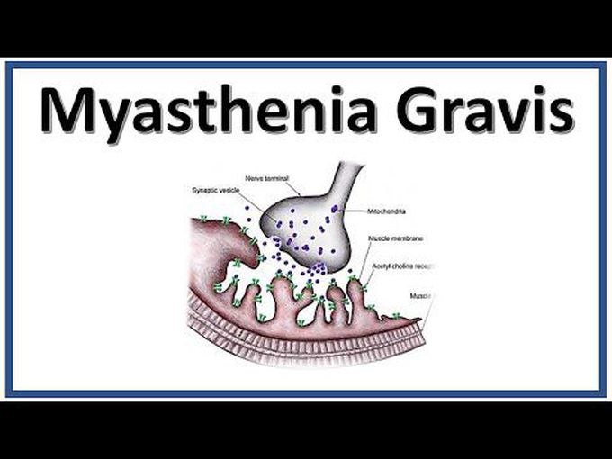 Important features of Myasthenia Gravis.