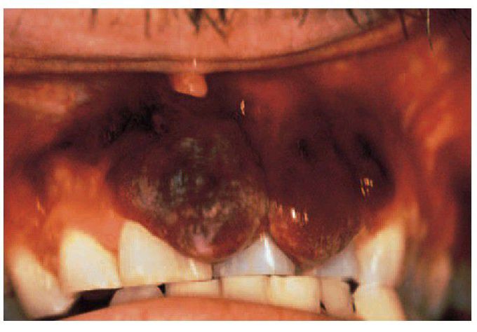 Kaposi’s sarcoma.