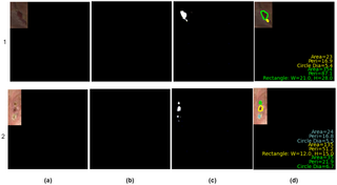 Automatic foot ulcer segmentation using conditional generative adversarial network (AFSegGAN): A wound management system