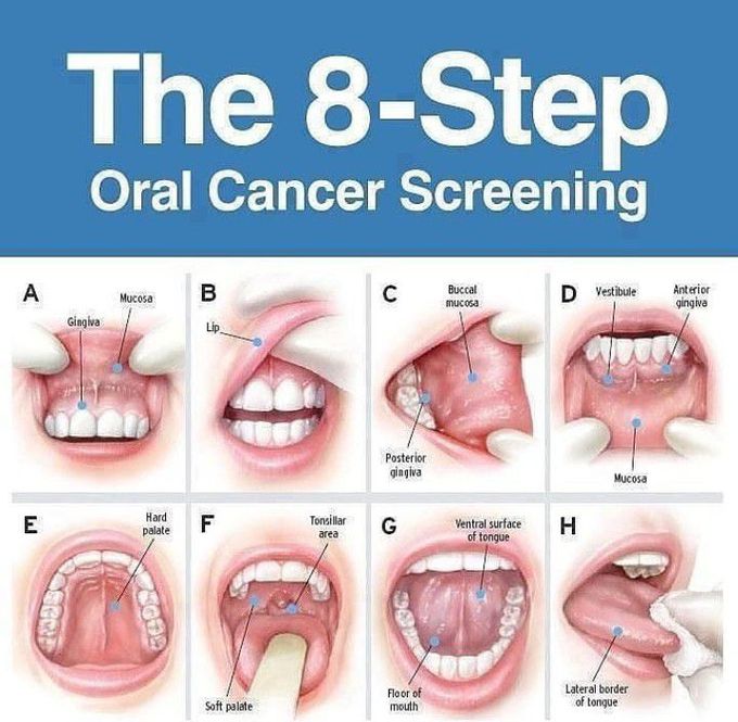 8-step oral cancer screening
