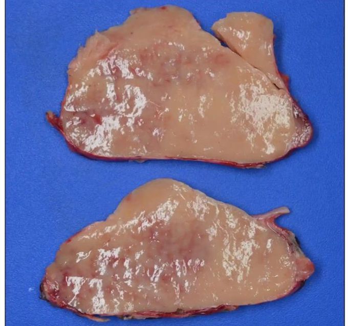 Intrathoracic Mass Turns out to be an Accessory Spleen