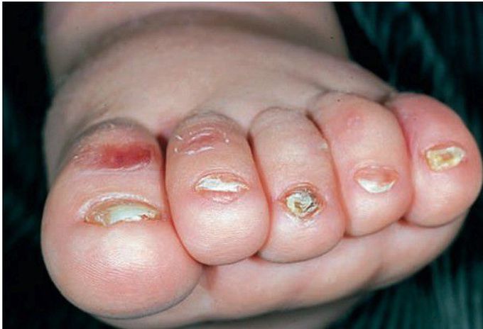 Epidermolysis bullosa