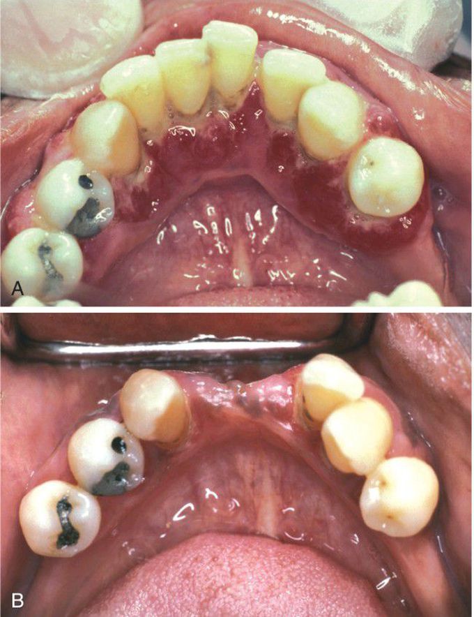 Diabetes Mellitus