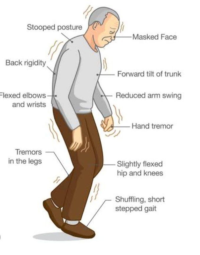 Parkinson's disease