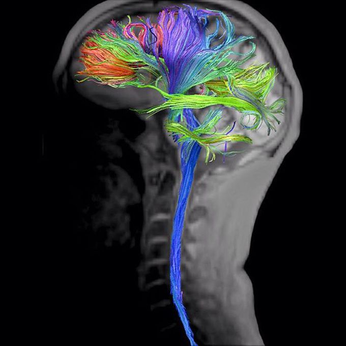 Brain and spine DTI Tractography based on RESOLVE sequence