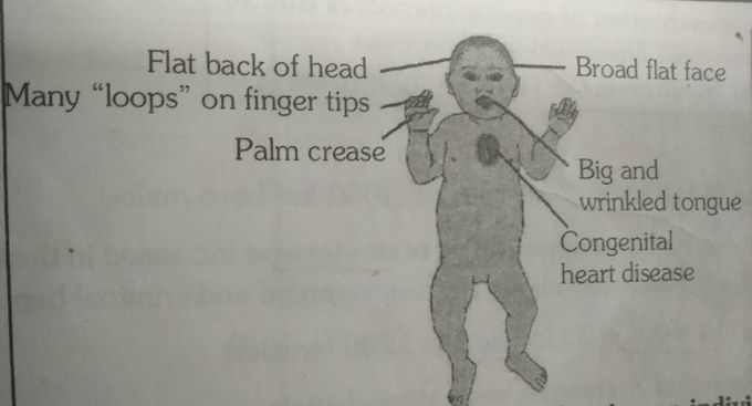 Can any one tell me which is this syndrome???