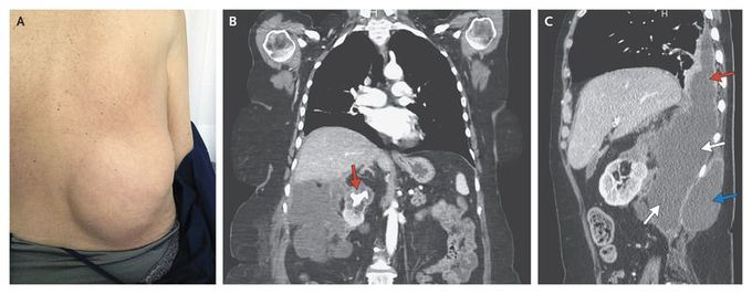 Chronic Obstructive Pyelonephritis