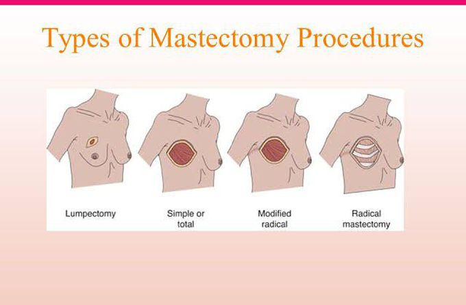 Mastectomy