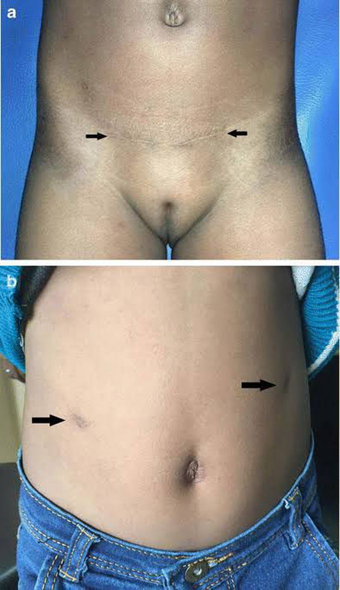 Choice of Repairing Inguinal Hernia in Children: Open Versus Laparoscopy