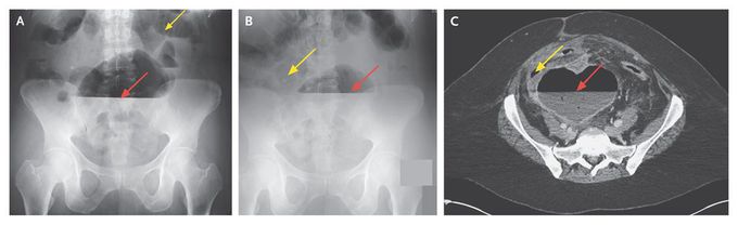 Mesenteric Abscess in Crohn's Disease