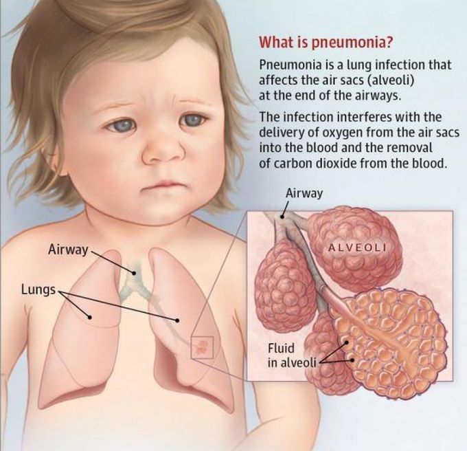 Pneumonia