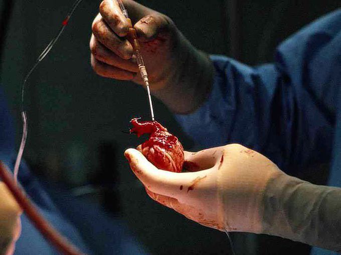 Pediatric heart transplantation