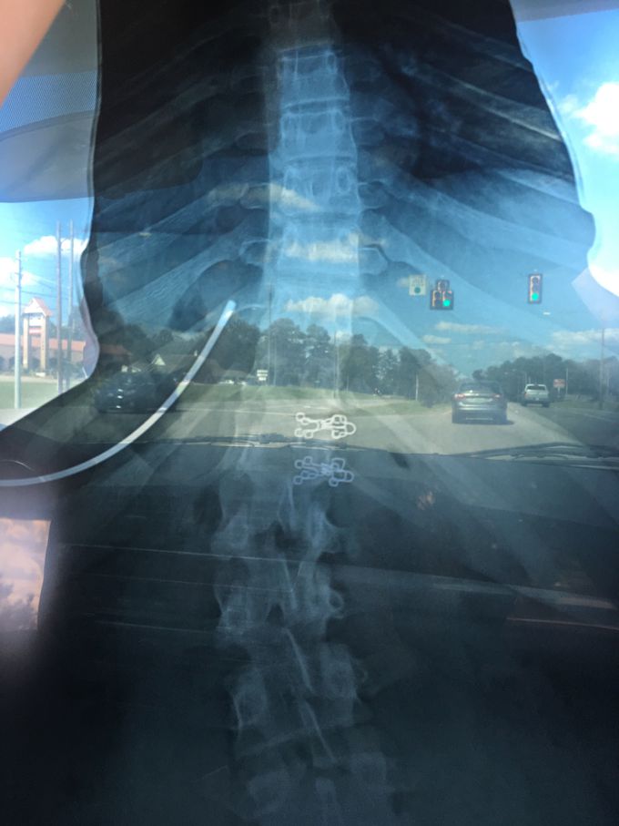 Scoliosis Inquiry Below!!