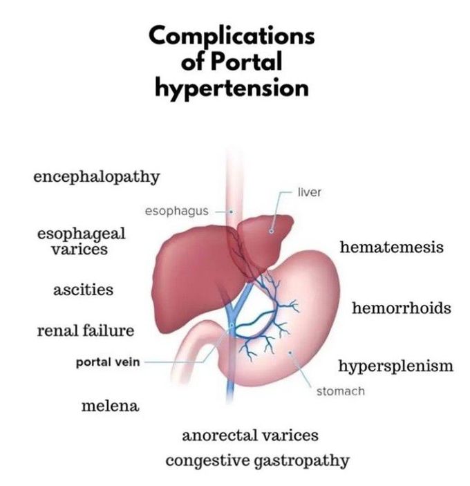 Complications of Portal Hypertension