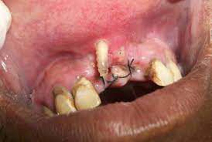 Oral myiasis