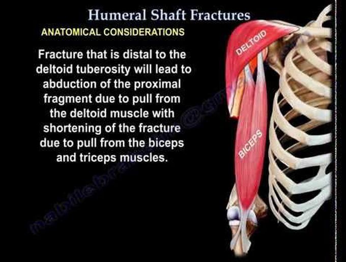 Fractures of Humerus
