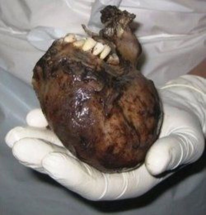 Teeth growing on a heart. A teratoma. - MEDizzy