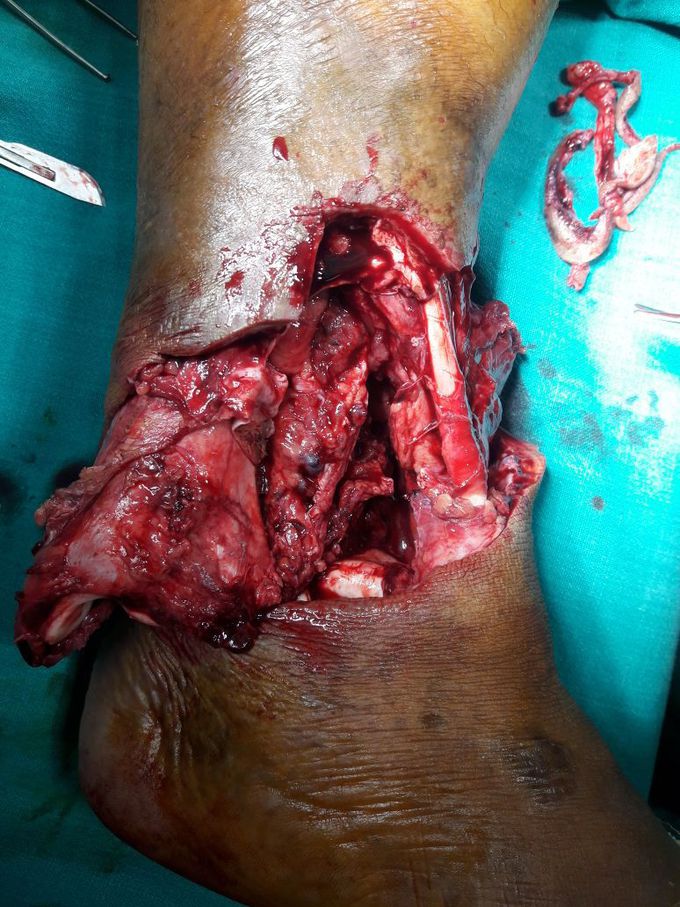 What's the treatment should be done??