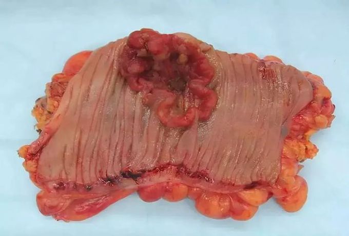 Colorectal Carcinoma