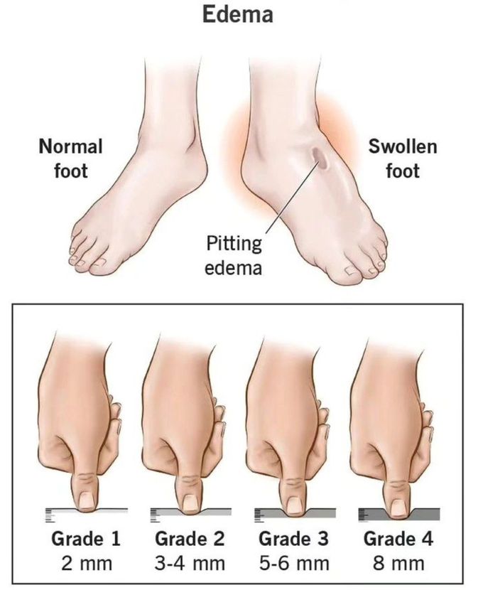 Grades of Edema