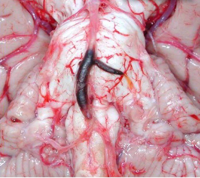 Basilar Artery Occlusion (BAD)