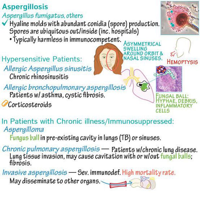 Aspergillosis - MEDizzy