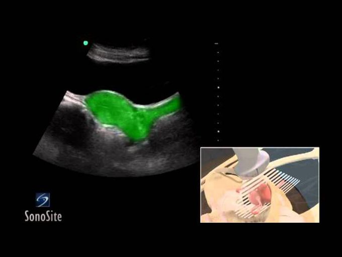 The female pelvis - ultrasonography