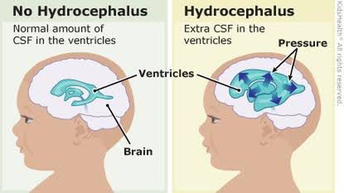Causes of hydrocephalus