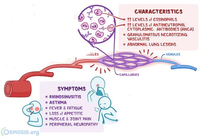 These are the symptoms of Chargg strauss syndrome