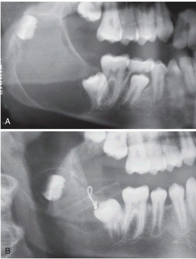 Decompression of an Odontogenic Keratocyst (OKC). - MEDizzy