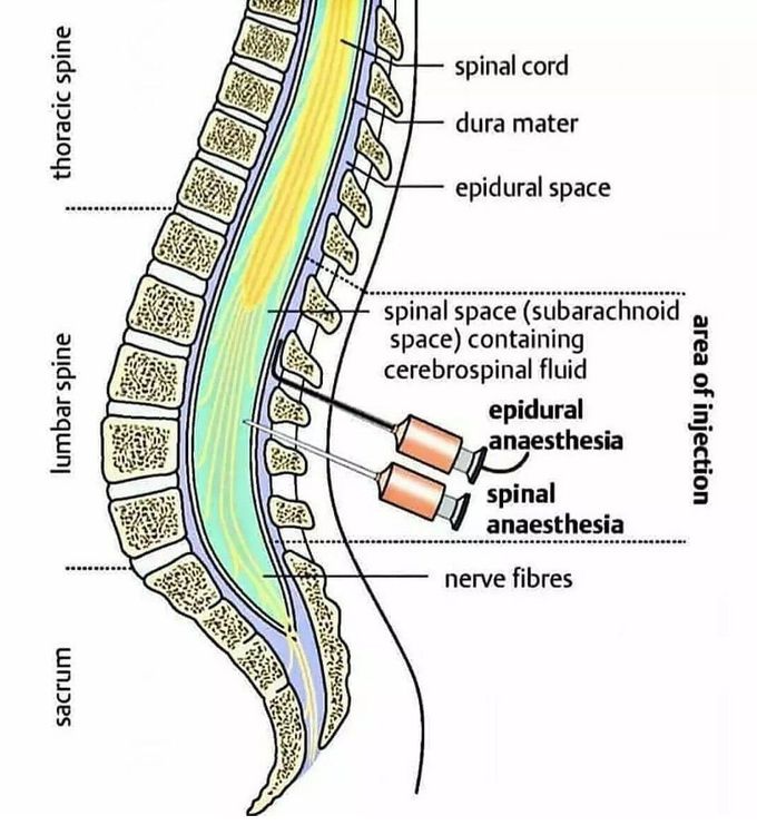 Epidural and Spinal Anaesthesia