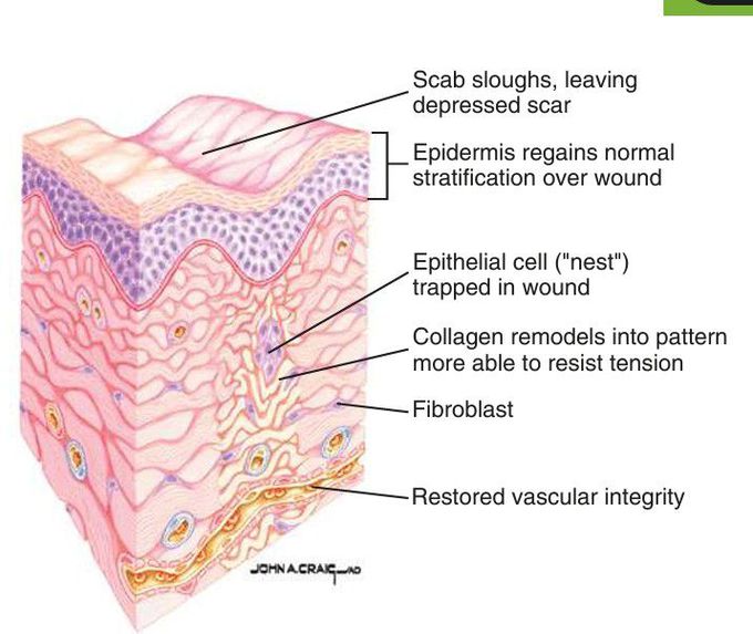 Remodeling stage of wound repair.